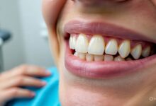 8 Clear Signs You Might Need Dental Implants
